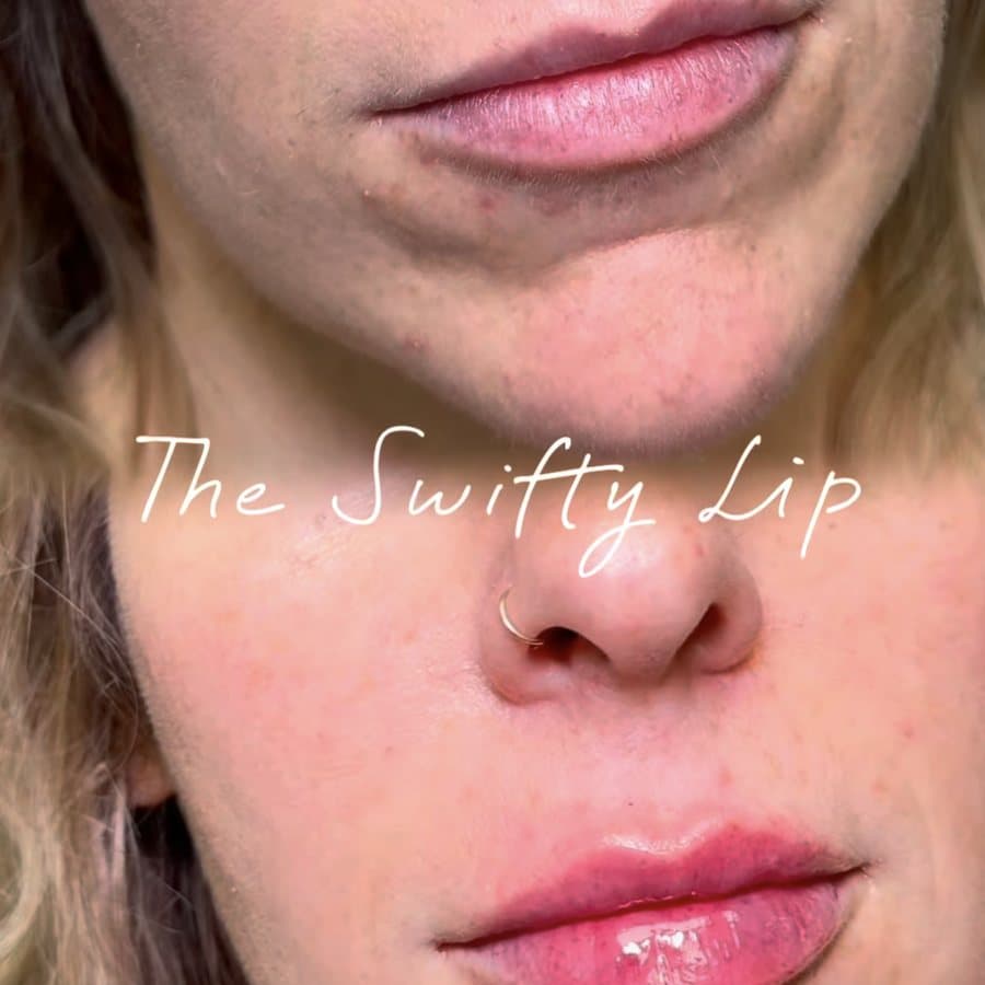 Lip filler before and after, captioned The Swifty Lip