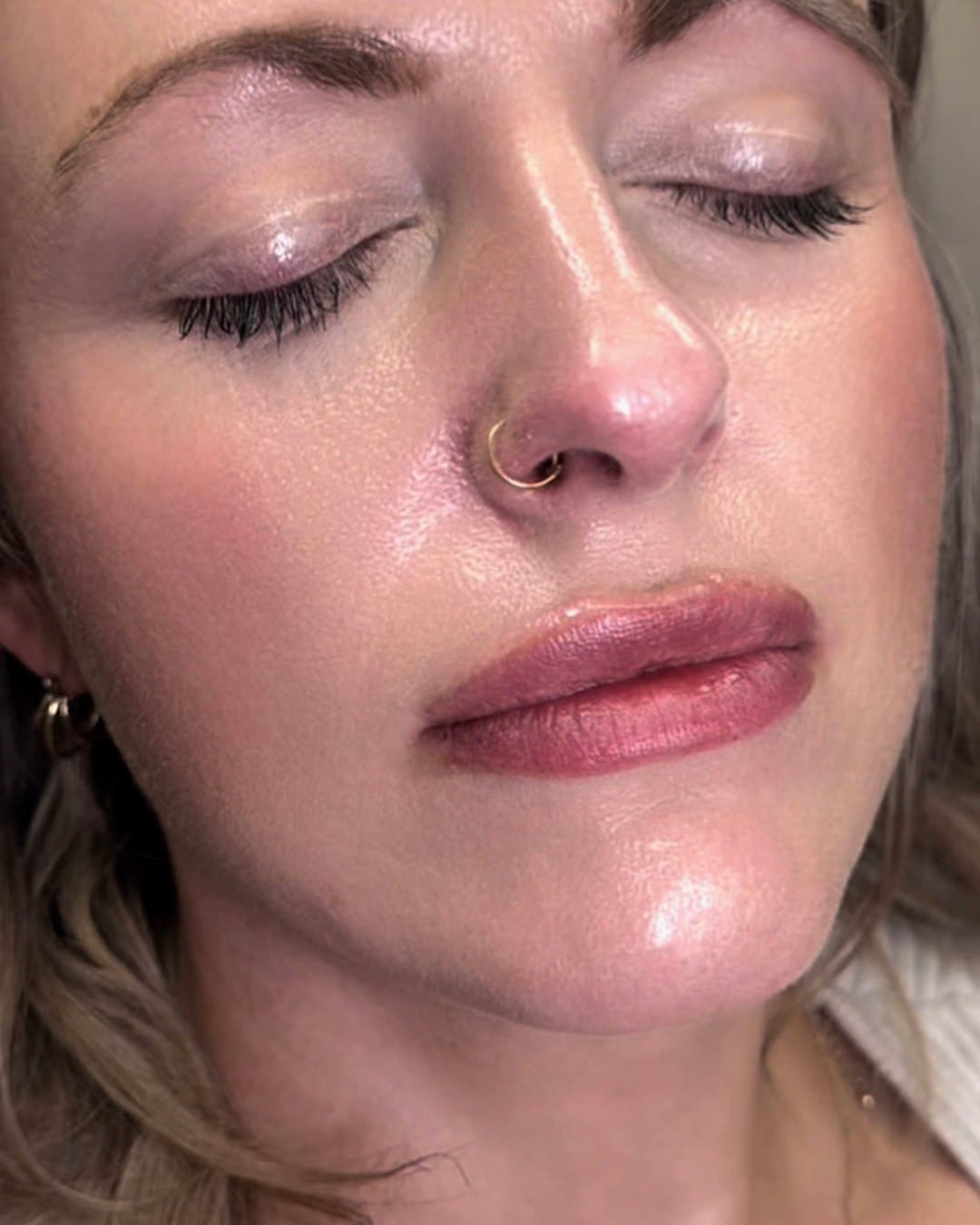 After, lip filler