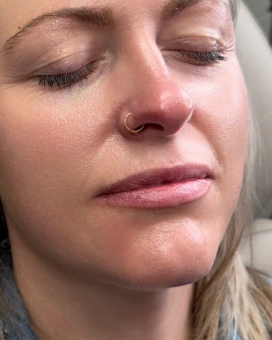 Before, lip filler